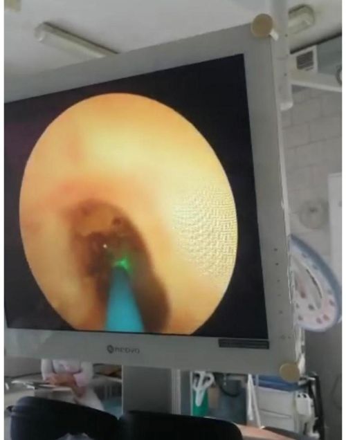 В Минусинскую межрайонную больницу поступил лазерный аппарат для лечения почечнокаменной болезни