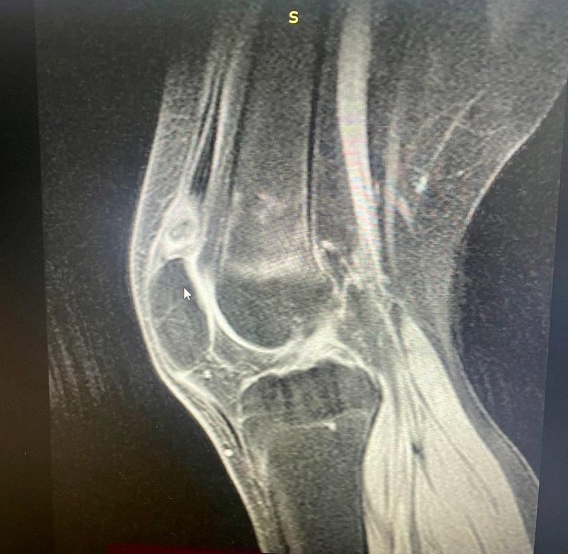 Красноярские врачи спасли пациента из Монголии с аномалией в коленном суставе